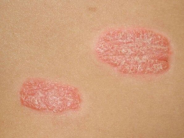 Clear, shiny skin border around papules
