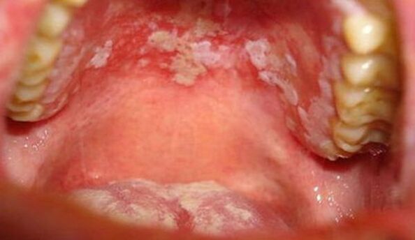 Mucous membrane psoriasis