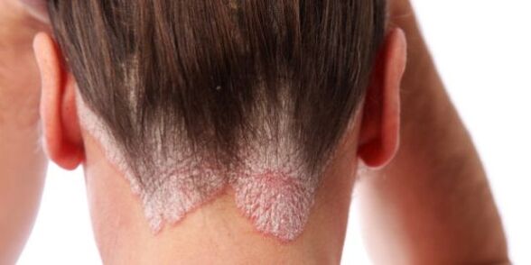 Well defined papules on the scalp. 