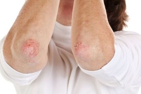 Manifestations of psoriasis on the elbows. 