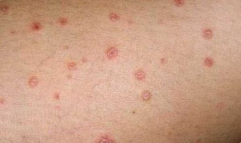 Manifestations of the initial stage of psoriasis on the skin. 