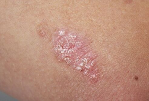 psoriatic plaque on the skin