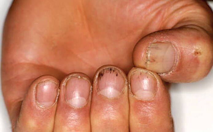 Hemorrhage under the nails with psoriasis. 