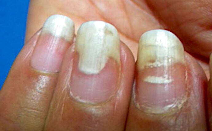 Onycholysis and leukonychia after manicure. 