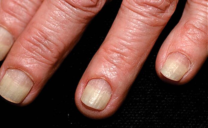 Propagation of onycholysis from the edge of the nail to the nail fold. 