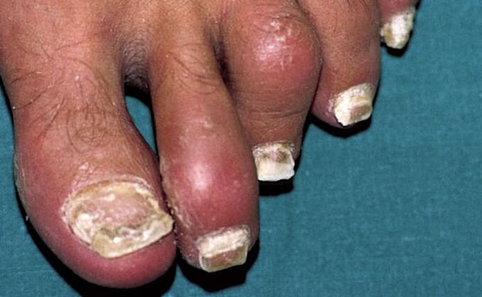 Psoriasis with involvement of the nails and inflammation of the joints (arthritis) of the toes