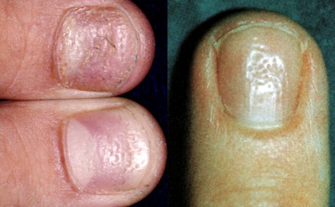 Thimble symptom multiple depressions on the nail plate surface