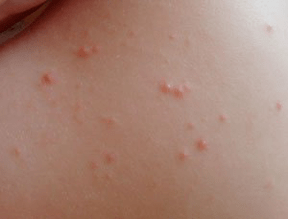 symptom of psoriasis rash